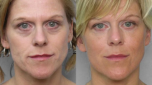 Picture of a woman before and after treatment with fat injection under the eyes.