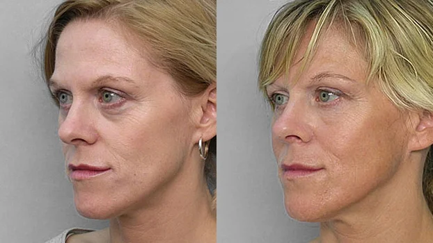 Picture of woman in semi-profile, before and after treatment with fat injection under the eyes.