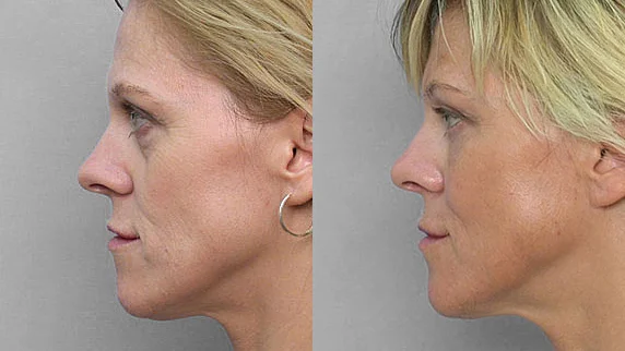 Picture of a woman in profile, before and after treatment with fat injection under the eyes.