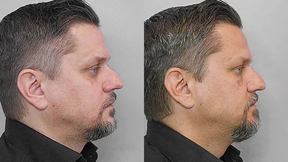 Before and after picture of a man in profile undergoing treatment with fat injection under the eyes.