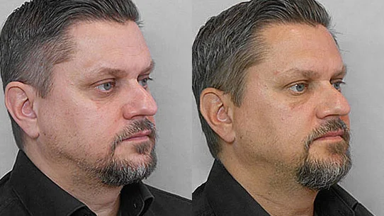 Before and after picture of a man in semi-profile, who has undergone treatment with fat injection under the eyes.