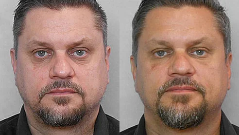 Before and after picture of a man who underwent treatment with fat injection under the eyes.