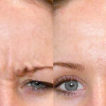 Before and after picture of a patient with a botox injection in the forehead.