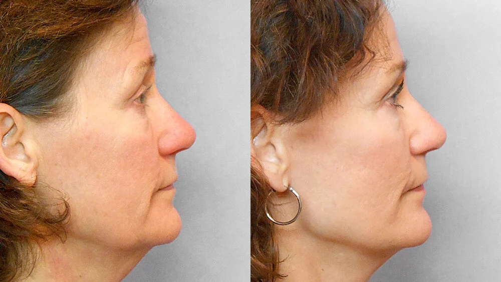 Before and after pictures of a woman who had a facelift, forehead lift, laser treatment and fat injection under the eyes.