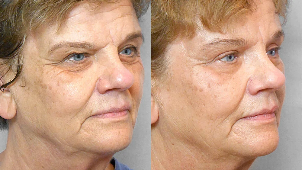 Half-profile before and after picture of a woman who has undergone a forehead lift, upper eyelid surgery and a fat injection under the eyes.