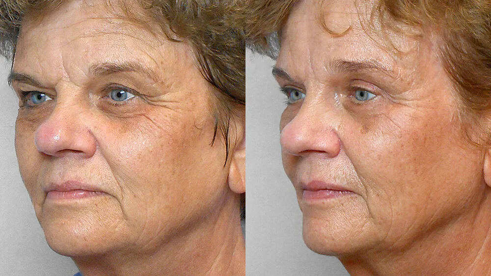 Half-profile before and after picture of a woman who has undergone a forehead lift, upper eyelid surgery and a fat injection under the eyes.
